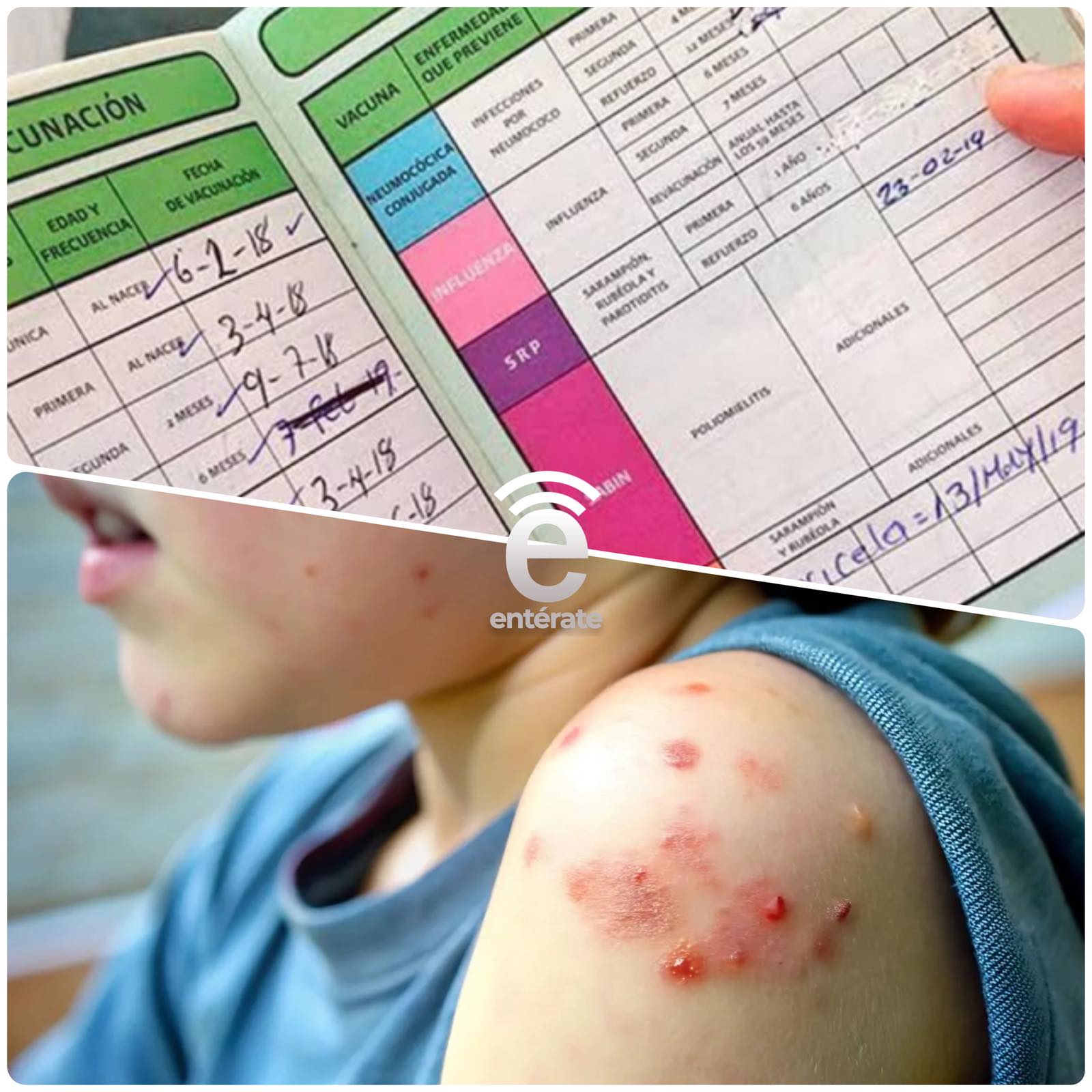 Sarampión es el virus más contagioso del mundo y causa amnesia inmunológica, revela investigador de la UAN